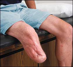 Transtibial Evaluation Prior to Casting
